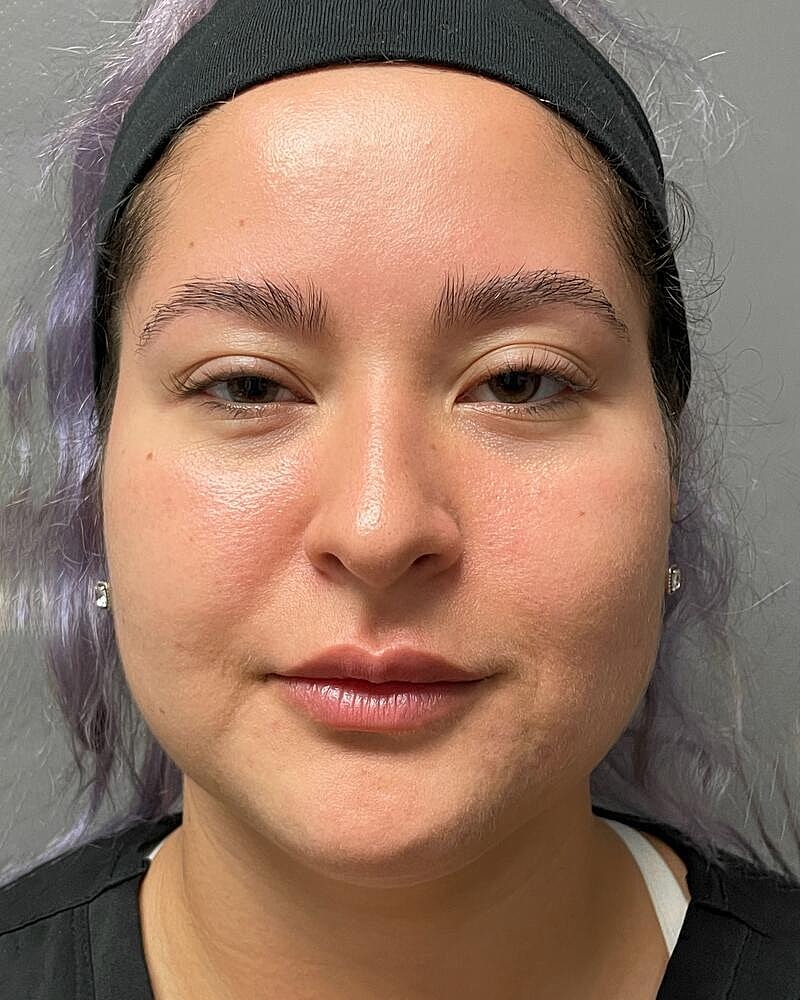 Buccal Fat Removal Before & After