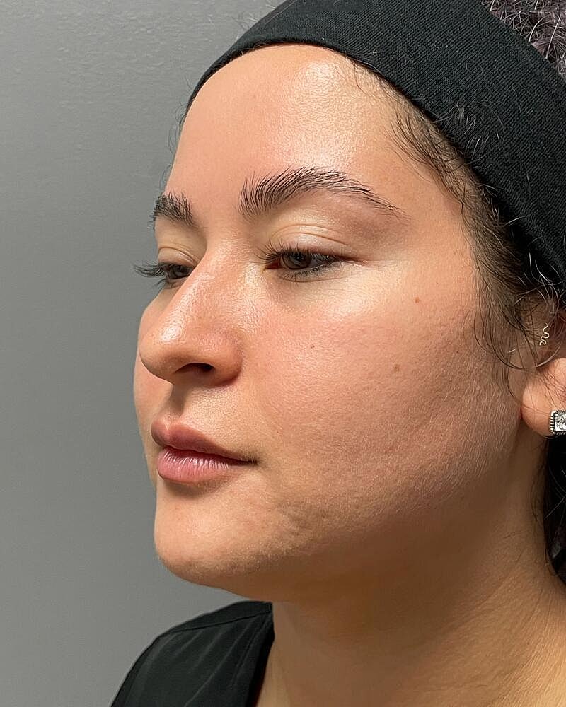 Buccal Fat Removal Before & After