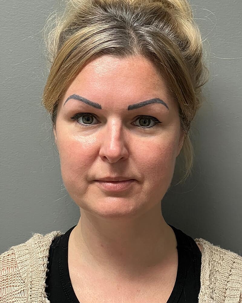 Buccal Fat Removal Before & After