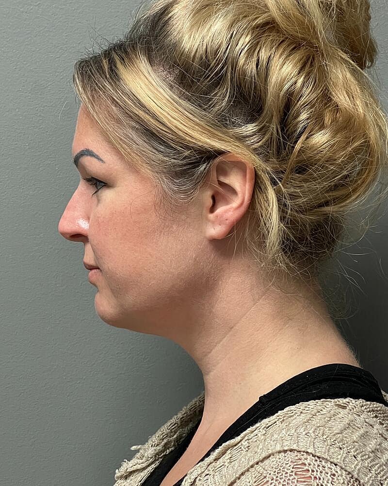 Buccal Fat Removal Before & After