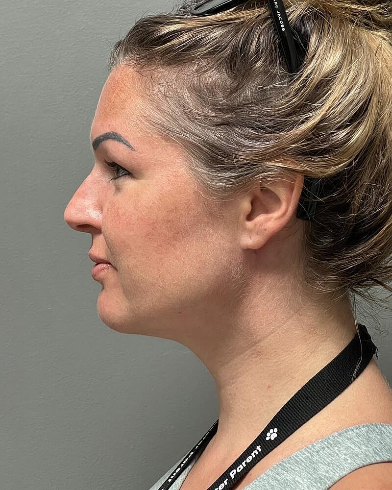 Buccal Fat Removal Before & After