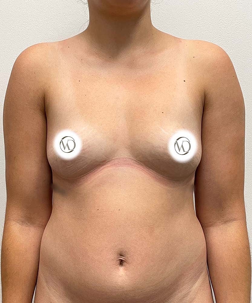 Fat Grafting To Breasts Before & After