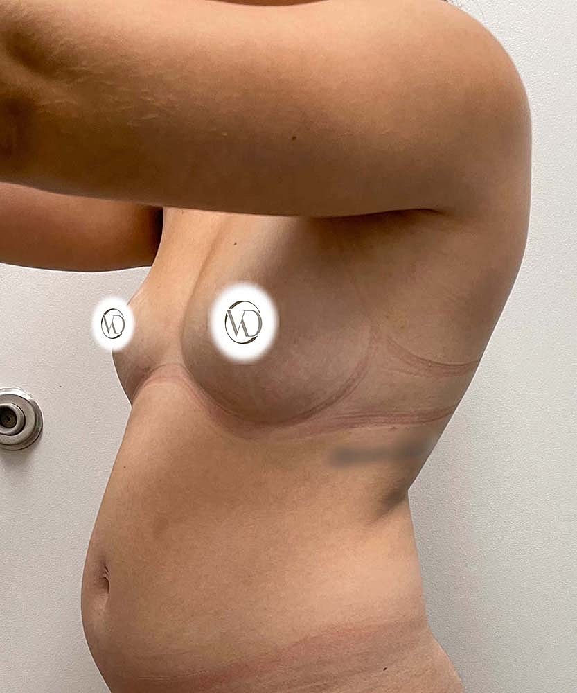 Fat Grafting To Breasts Before & After
