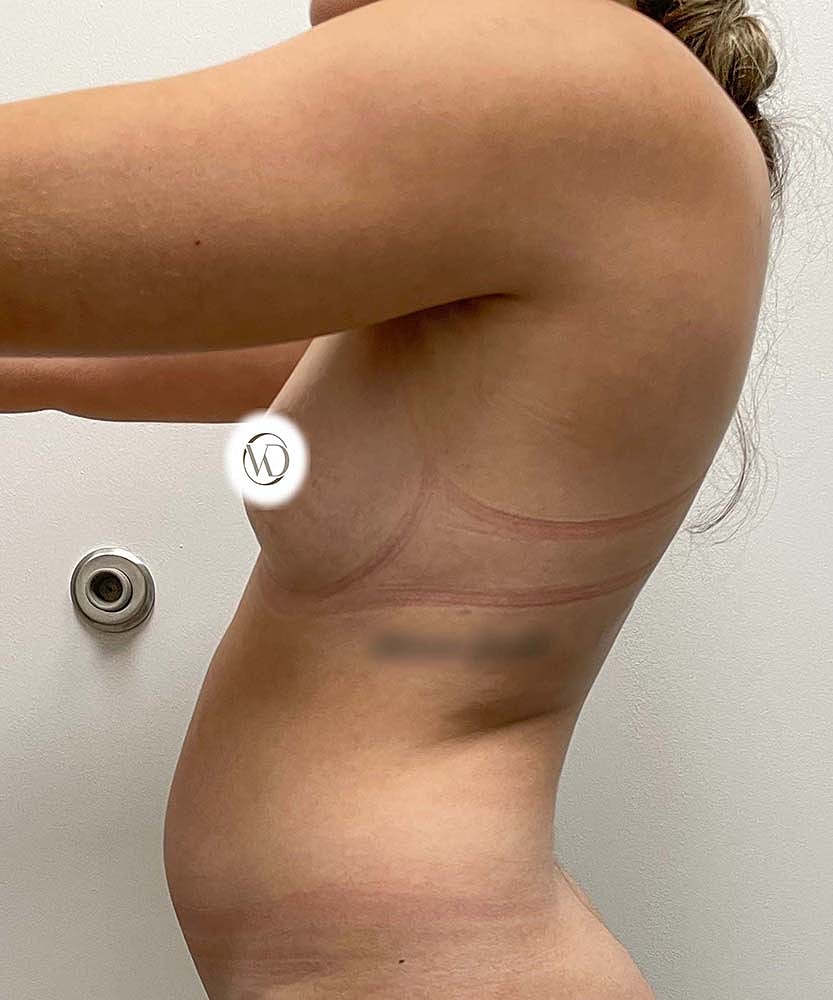 Fat Grafting To Breasts Before & After