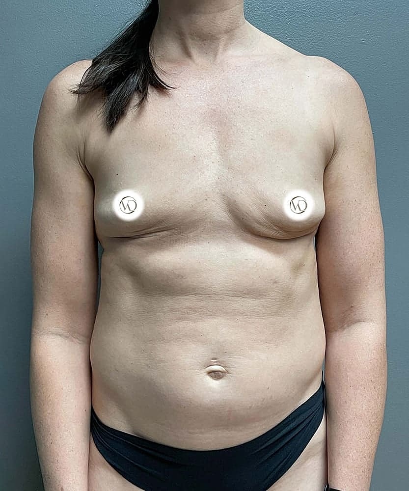 Fat Grafting To Breasts Before & After