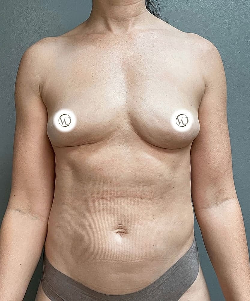 Fat Grafting To Breasts Before & After