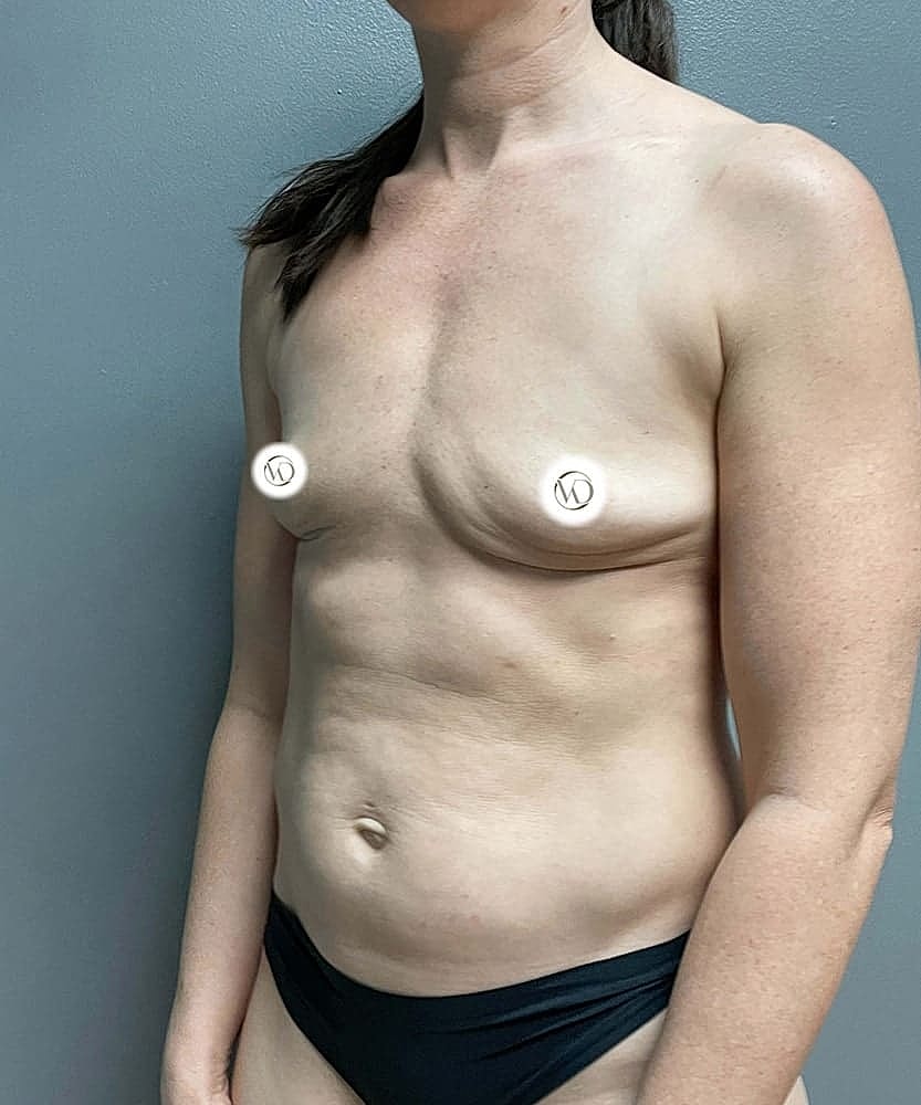 Fat Grafting To Breasts Before & After