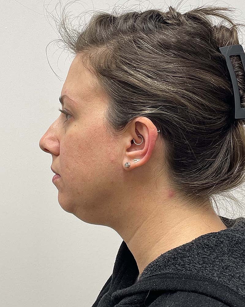 Chin Liposuction Before & After