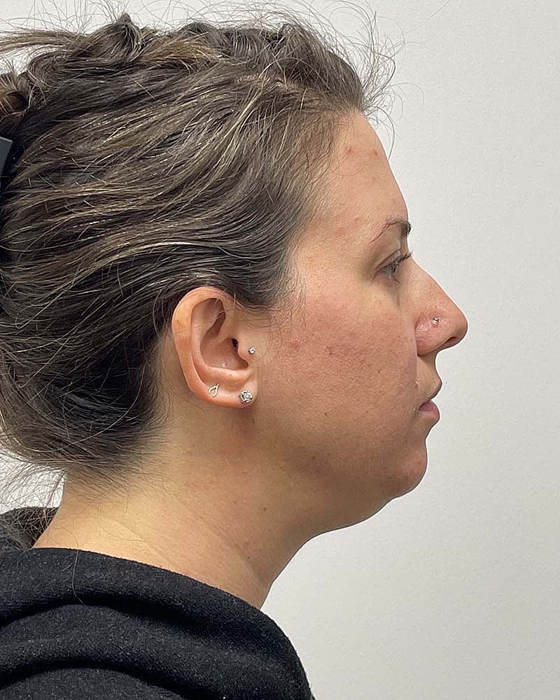 Chin Liposuction Before & After