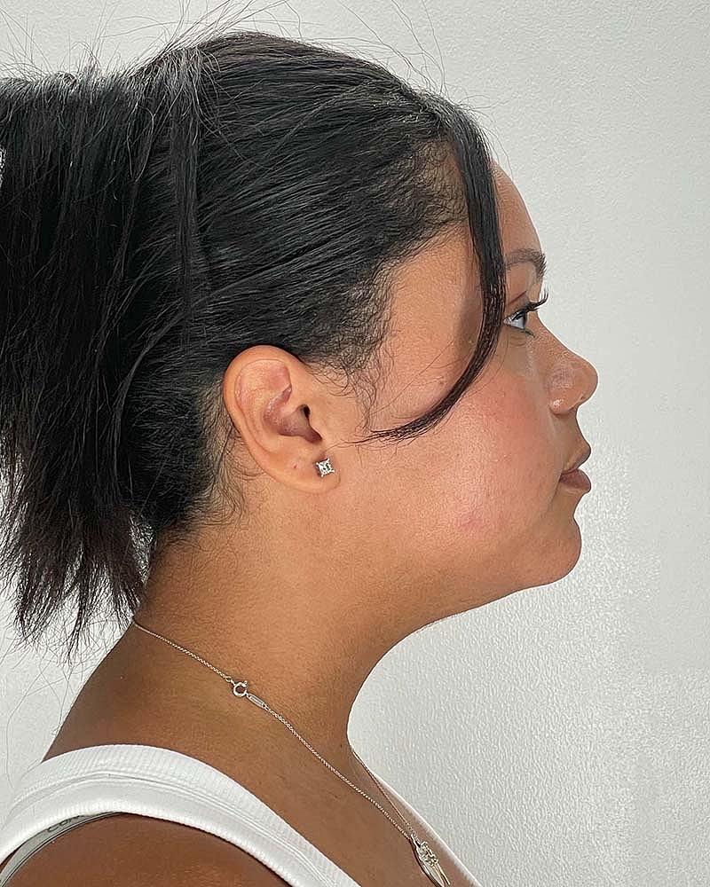 Chin Liposuction Before & After