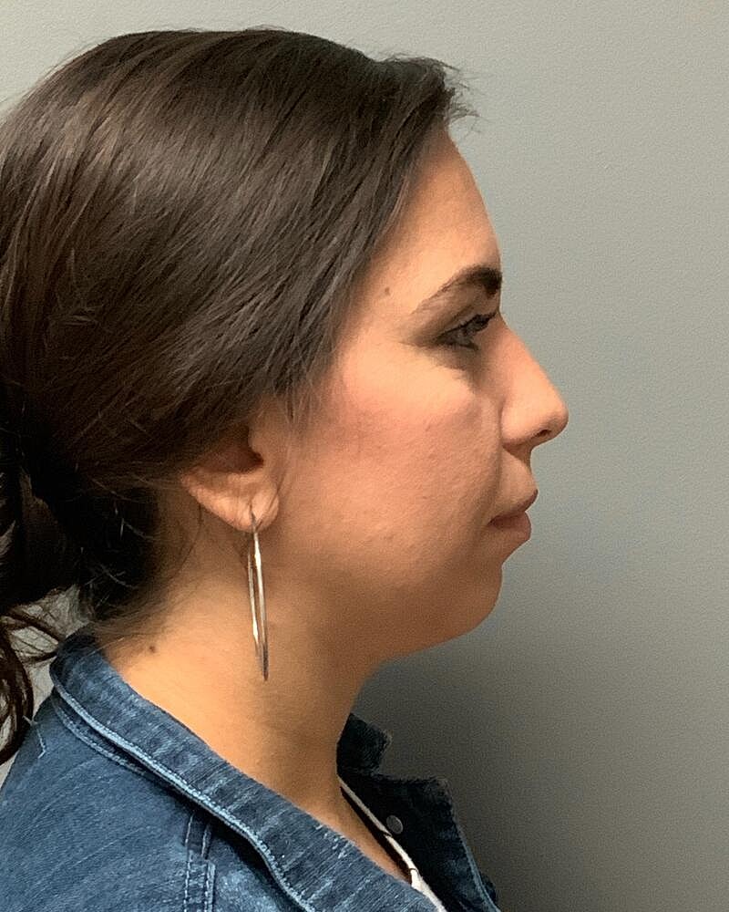 Chin Liposuction Before & After