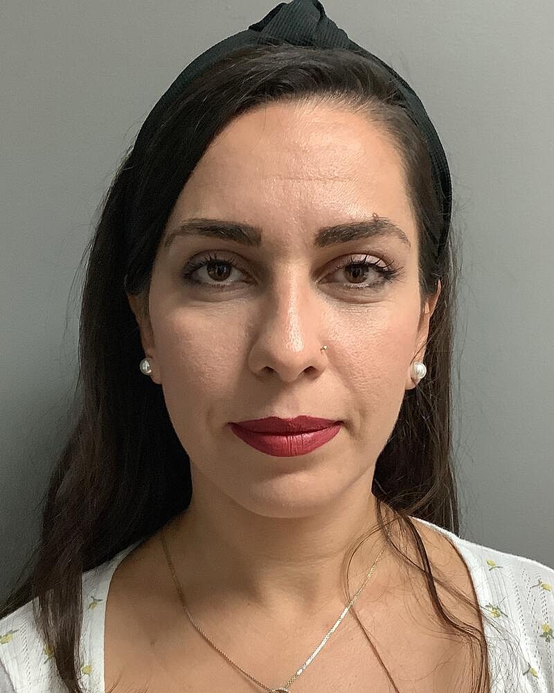 Chin Liposuction Before & After