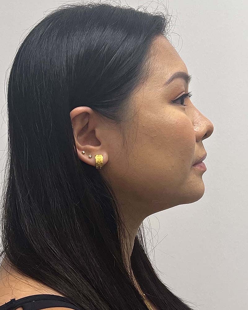 Chin Liposuction Before & After