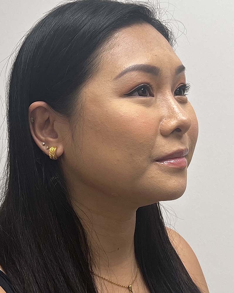 Chin Liposuction Before & After