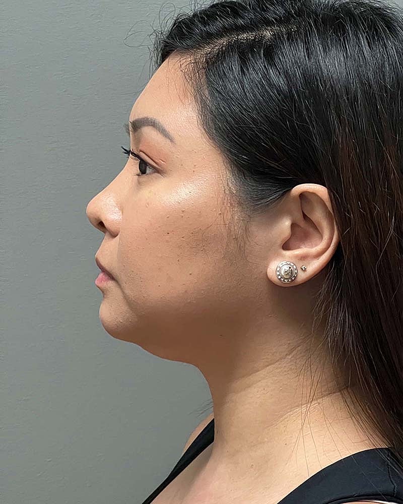 Chin Liposuction Before & After