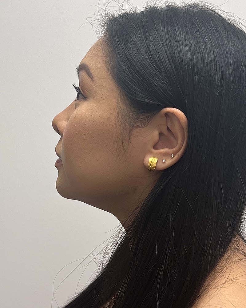 Chin Liposuction Before & After