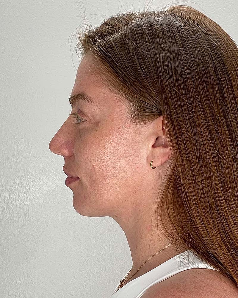 Chin Liposuction Before & After