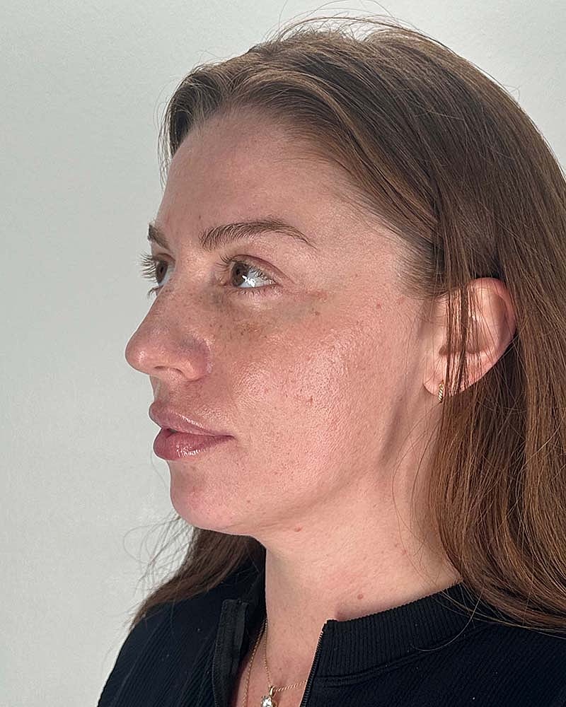 Chin Liposuction Before & After