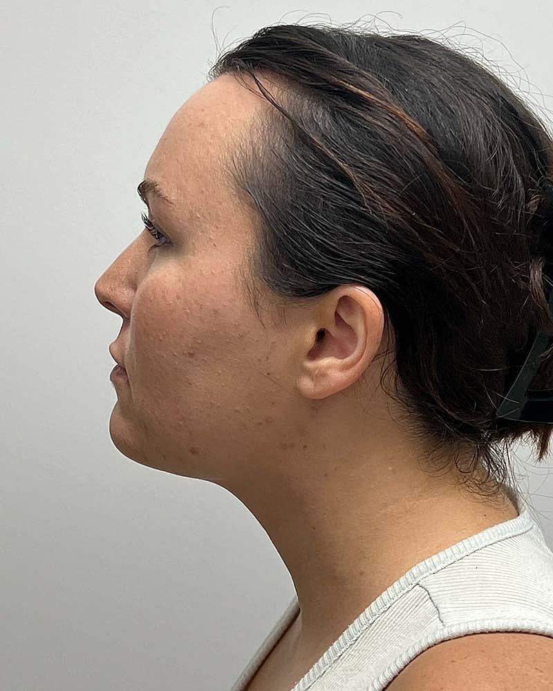 Chin Liposuction Before & After