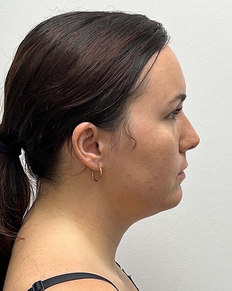 Chin Liposuction Before & After