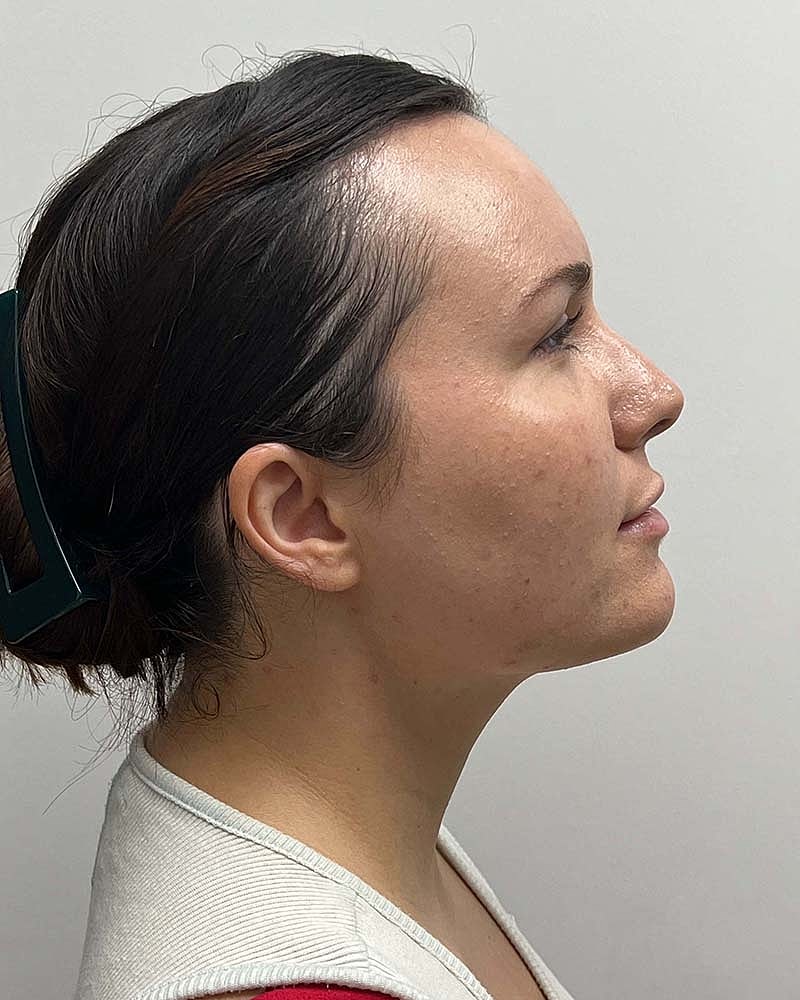 Chin Liposuction Before & After
