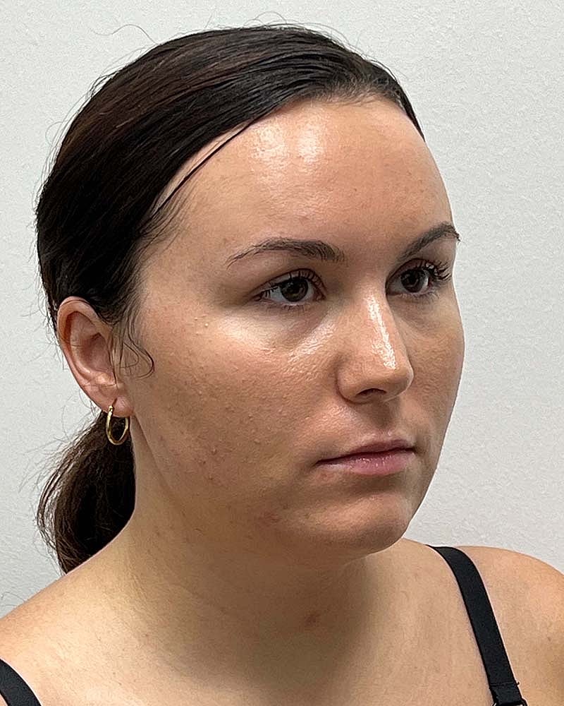 Chin Liposuction Before & After