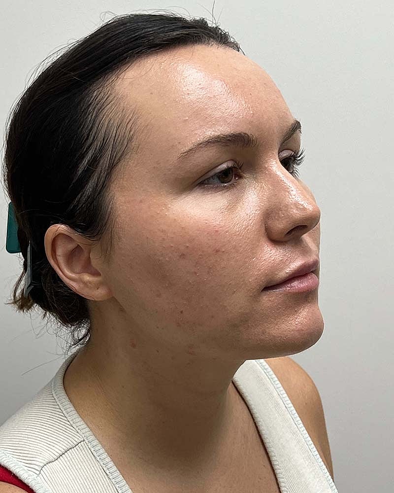 Chin Liposuction Before & After