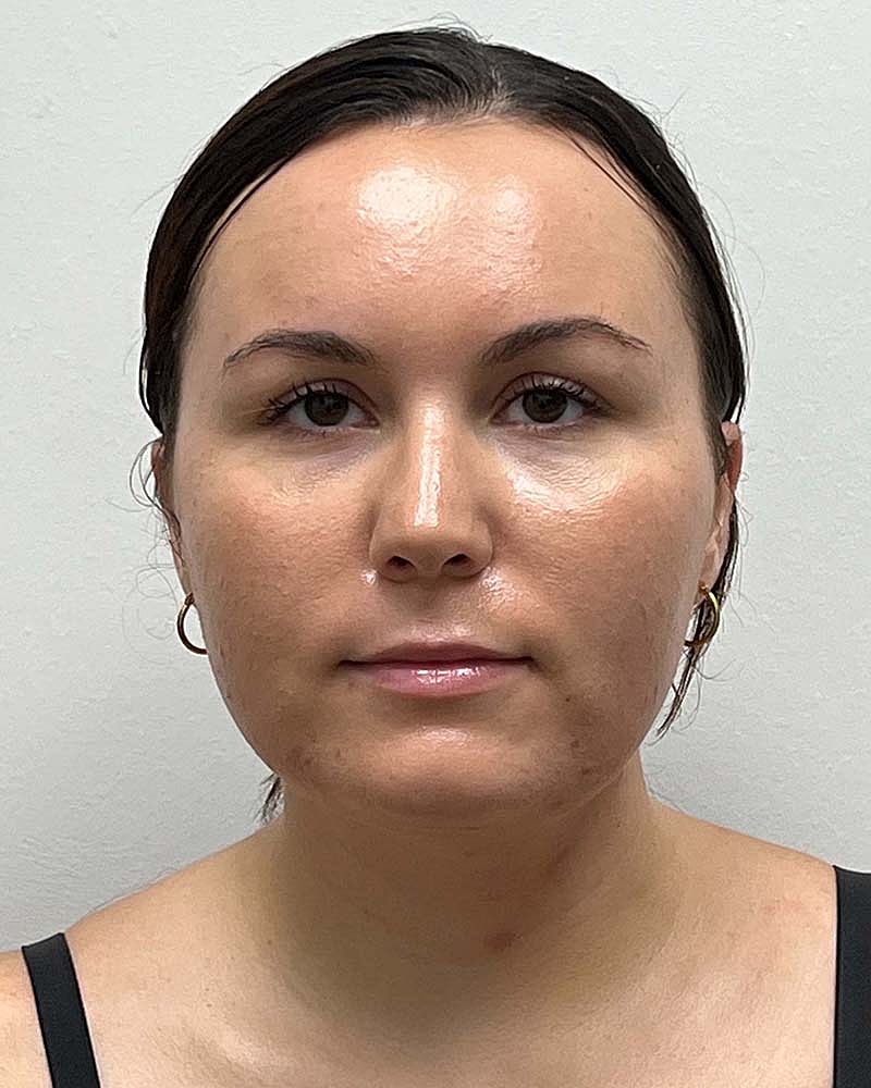 Chin Liposuction Before & After