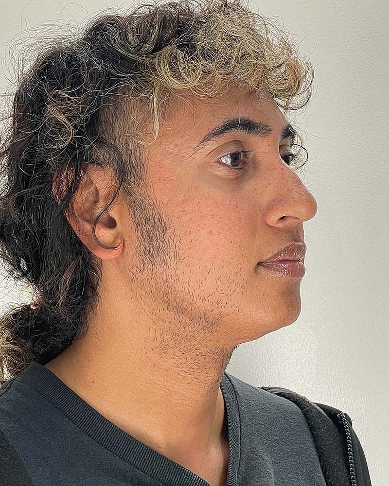 Chin Liposuction Before & After