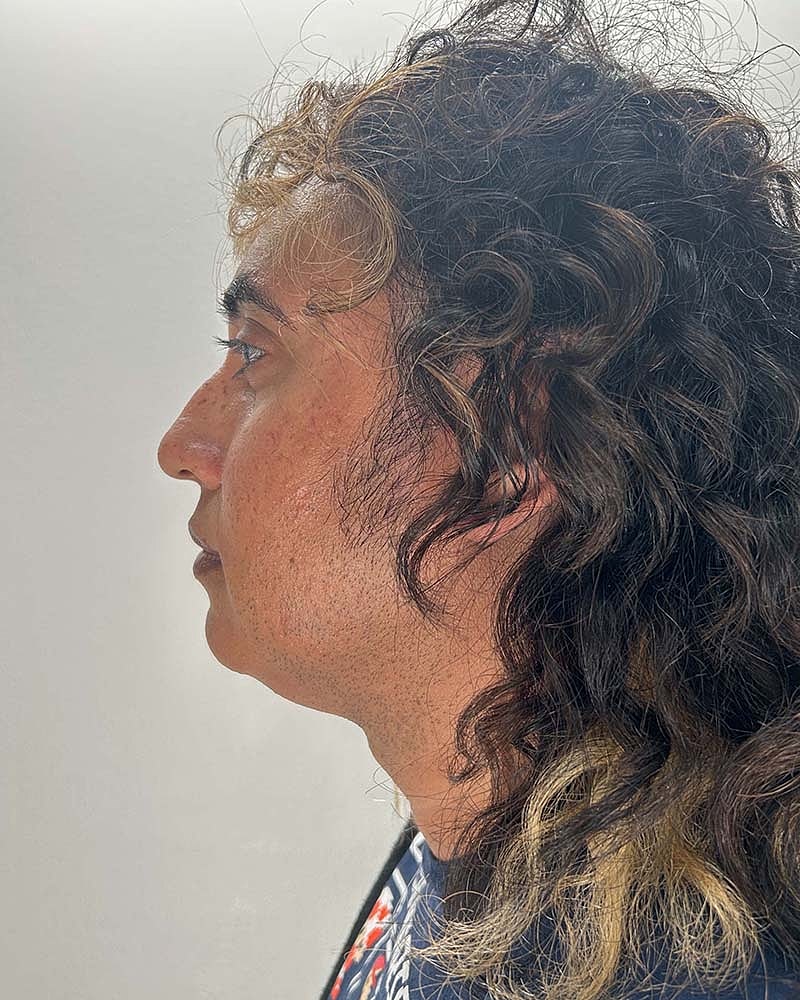 Chin Liposuction Before & After