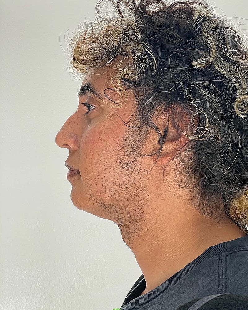 Chin Liposuction Before & After