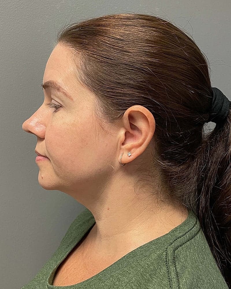 Chin Liposuction Before & After