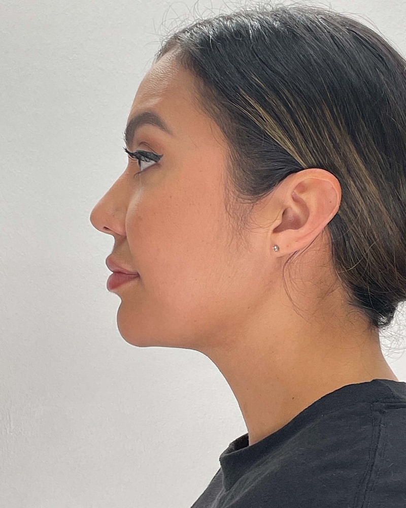Chin Liposuction Before & After