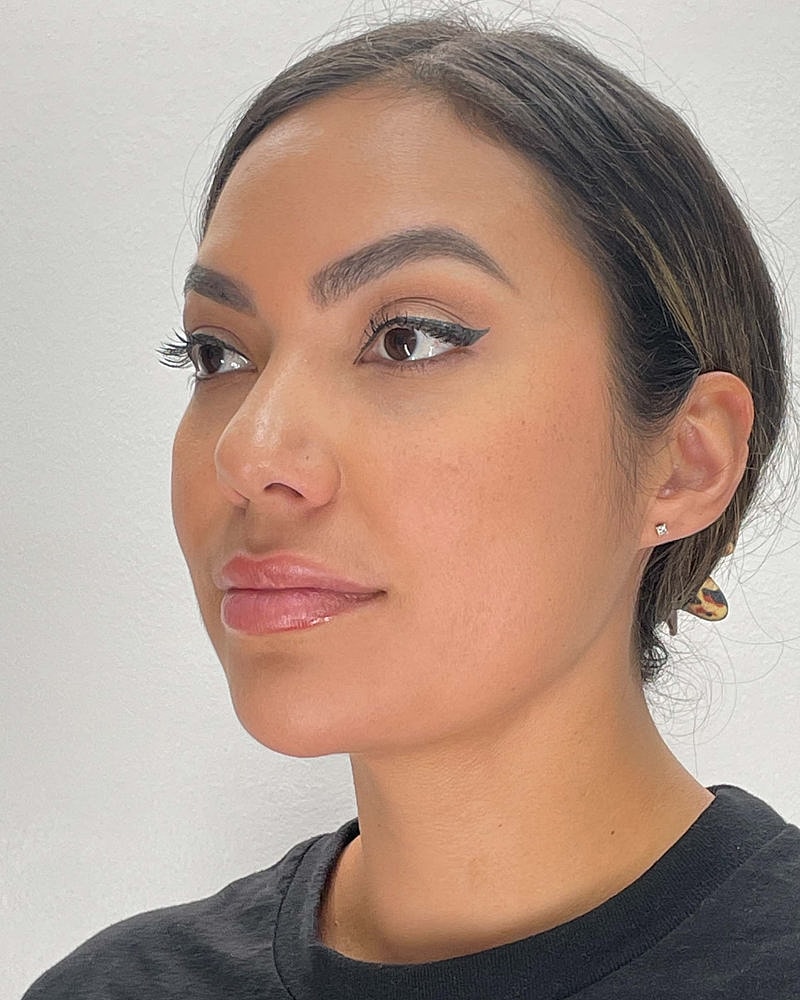 Chin Liposuction Before & After