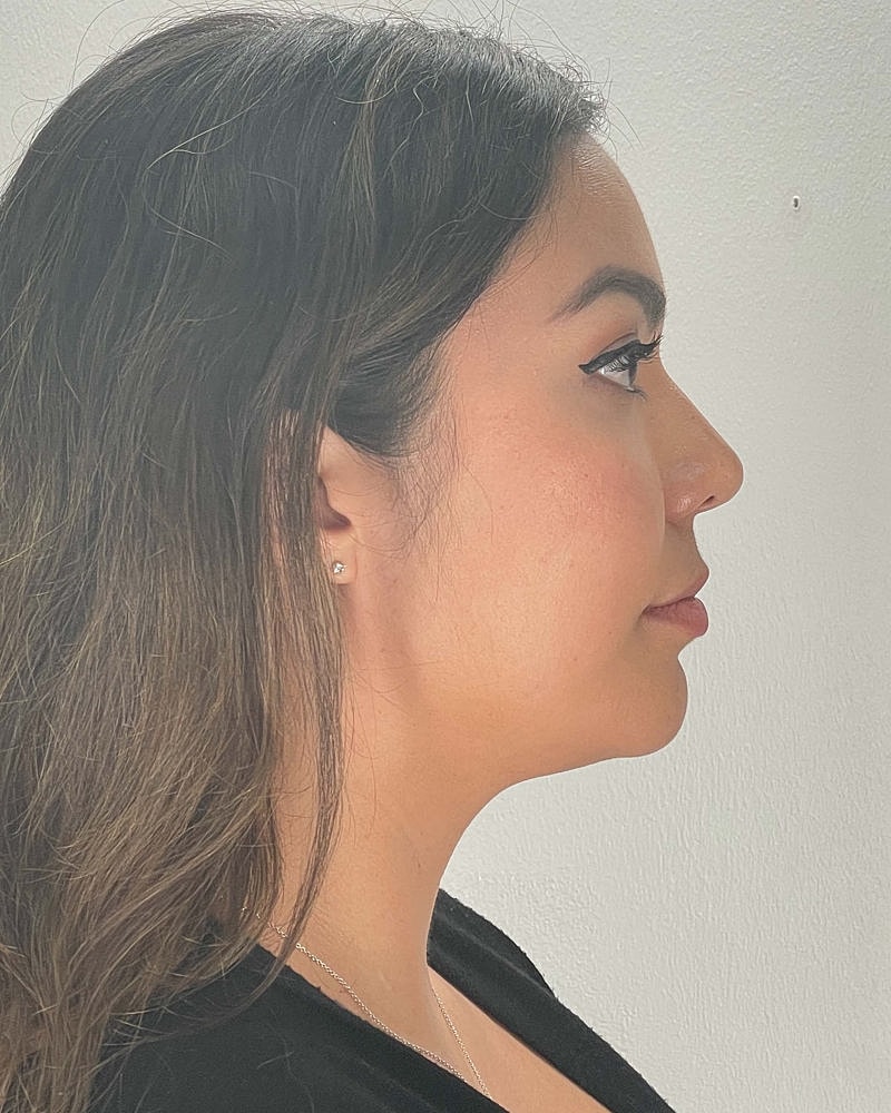 Chin Liposuction Before & After