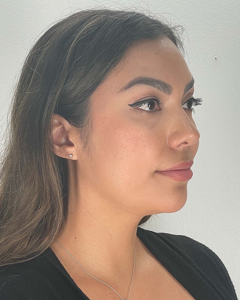 Chin Liposuction Before & After