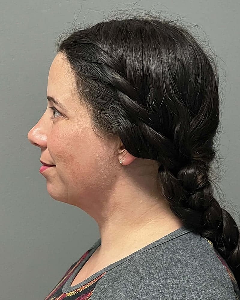 Chin Liposuction Before & After