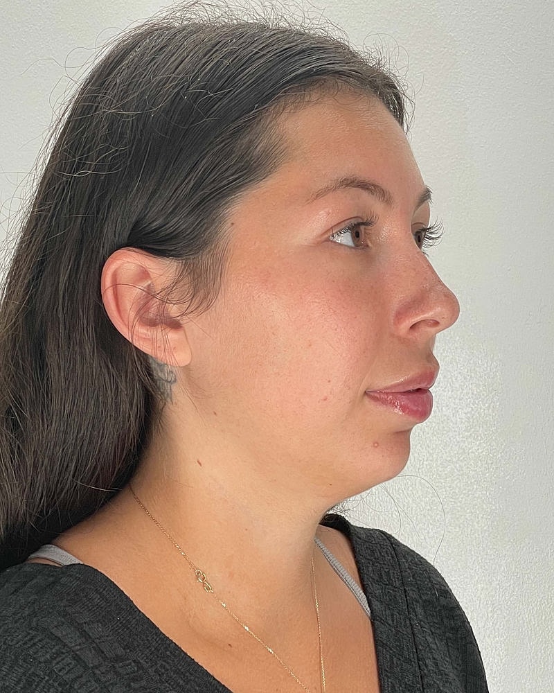 Chin Liposuction Before & After