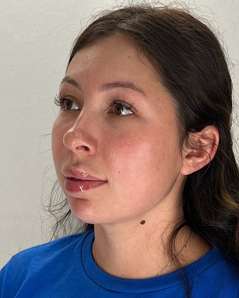 Chin Liposuction Before & After
