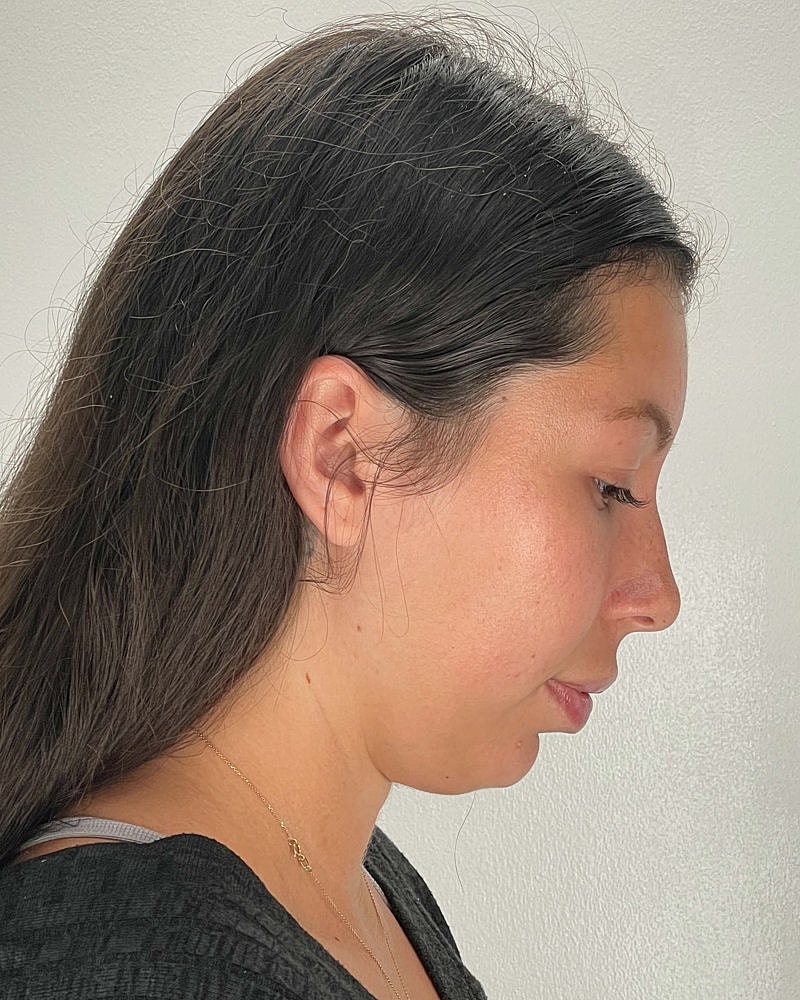 Chin Liposuction Before & After