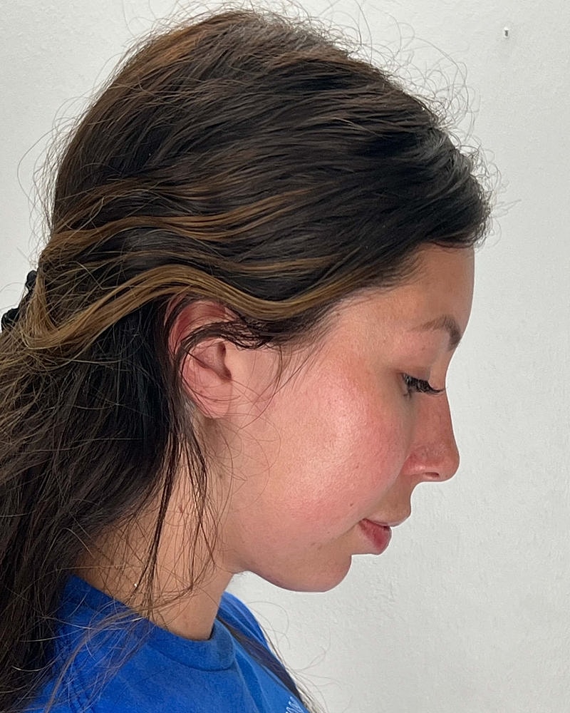 Chin Liposuction Before & After