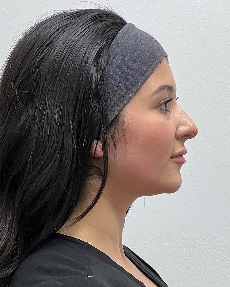 Chin Liposuction Before & After