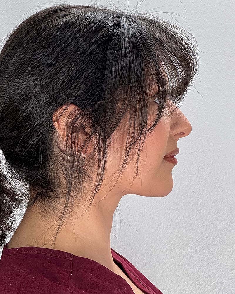 Chin Liposuction Before & After