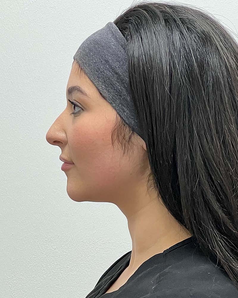 Chin Liposuction Before & After