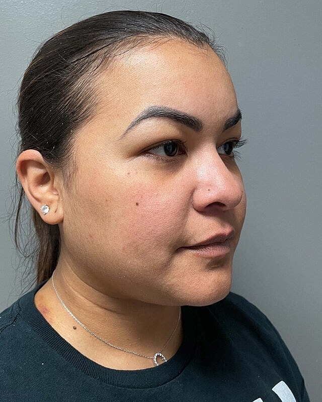Chin Liposuction Before & After