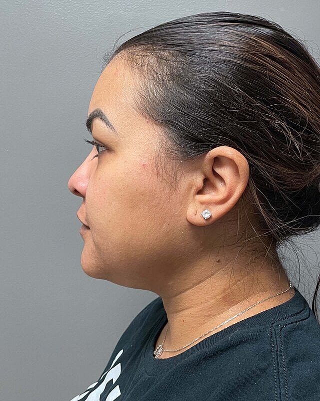 Chin Liposuction Before & After