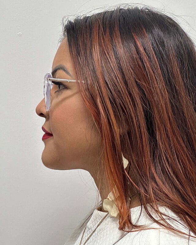 Chin Liposuction Before & After