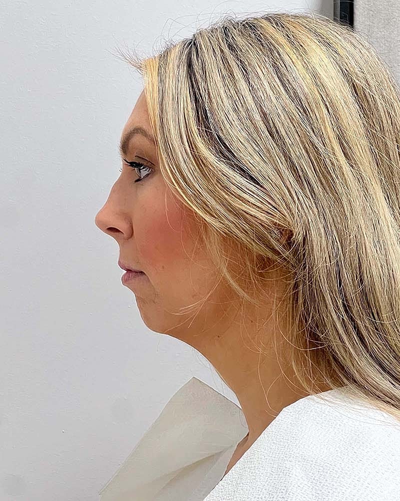 Chin Liposuction Before & After