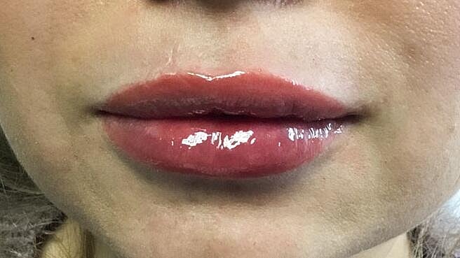 Juvederm Before & After