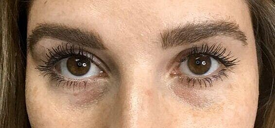 Juvederm Before & After